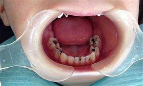 治疗中的儿童龋齿