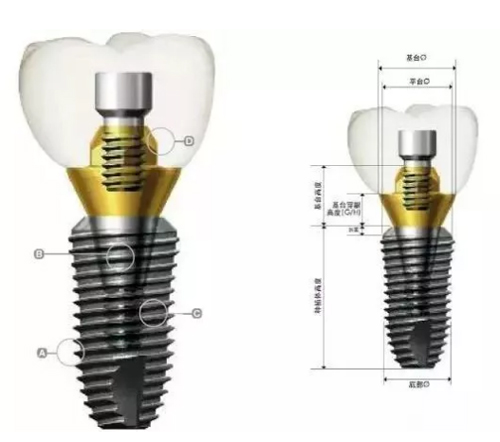 韩国登腾种植牙3900元一颗贵吗？韩国登腾种植牙质量怎么样?