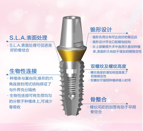 韩国登腾种植牙3900元一颗贵吗？韩国登腾种植牙质量怎么样?