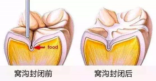 窝沟封闭治疗前后示意图