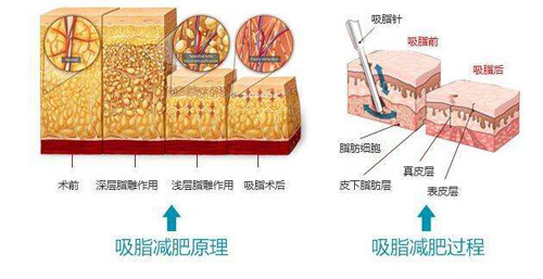 吸脂减肥手术原理