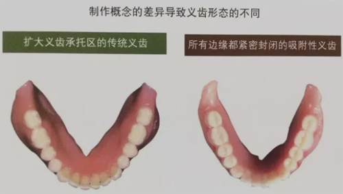 吸附性义齿和普通义齿对比