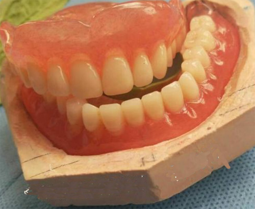 吸附性义齿模型