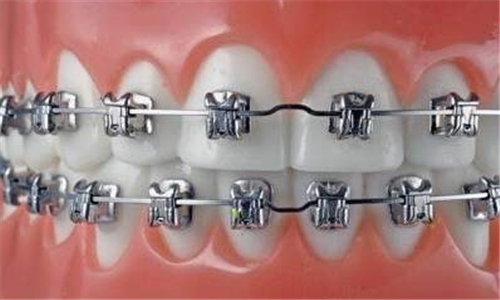 金属托槽矫正牙齿