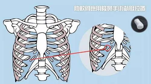 肋軟骨隆鼻取肋骨位置