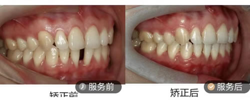 武汉皓诺口腔医院牙齿矫正图片