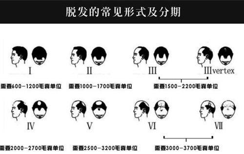 脱发等级和植发数量图示