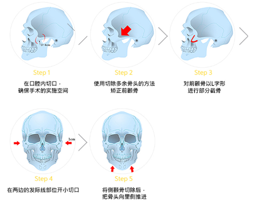 韩国珠儿丽整形医院颧骨整形方法
