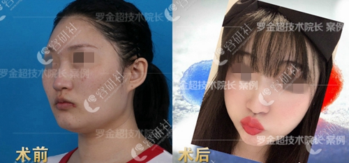 北京联合丽格医疗美容医院颧骨整形案例