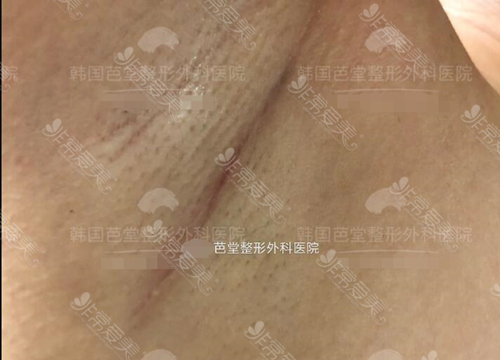 韩国芭堂假体隆胸腋下切口四个月疤痕图