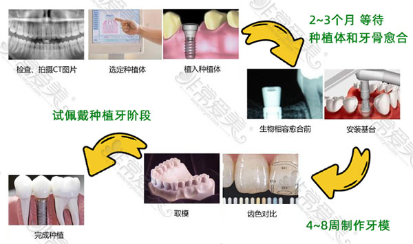 种植牙流程及周期表分享:快看看种牙要多久可以种好！