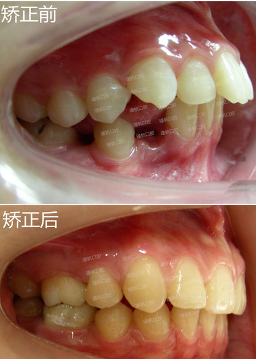 桂林瑾帆口腔醫(yī)院牙齒矯對比