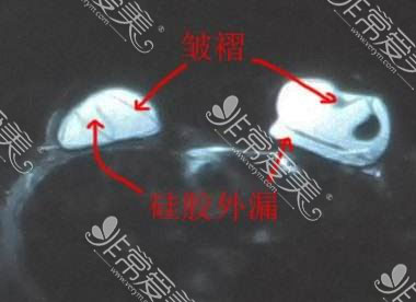 隆胸假体破裂CT照片