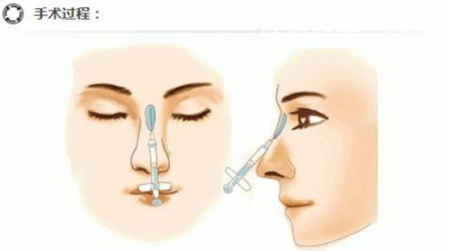 玻尿酸注射隆鼻
