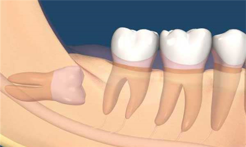 智齿生长位置不正
