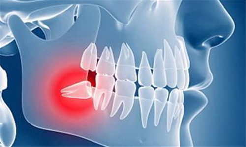 智齿引起炎症