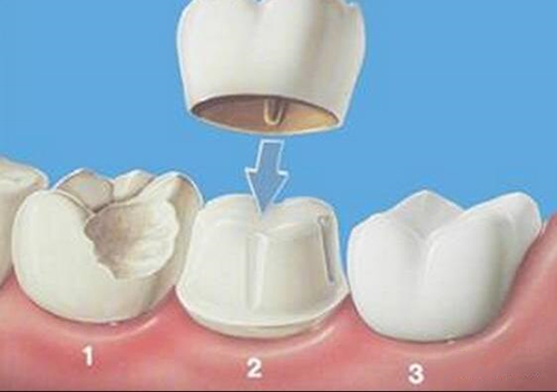 牙齿冠修复示意图