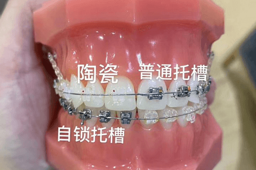 矫正牙齿不同方式 