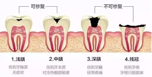 齲齒的不同情況展示