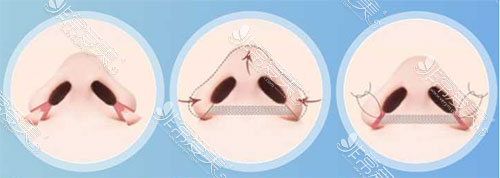 缩鼻翼手术方法图片