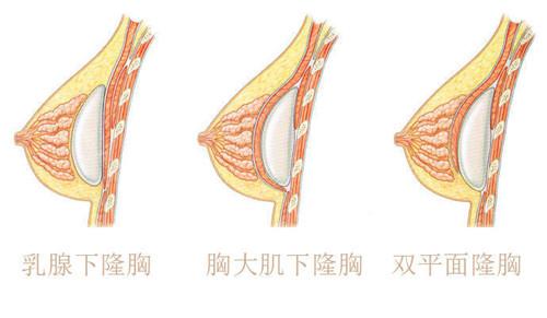 隆胸假体植入的三个层次