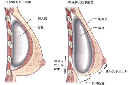 假体植入层次