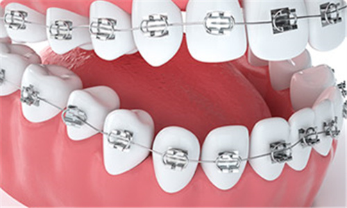 牙齿矫正系统