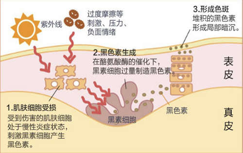 面部斑点形成过程