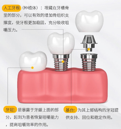 种植牙结构介绍