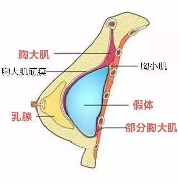 假体隆胸图示