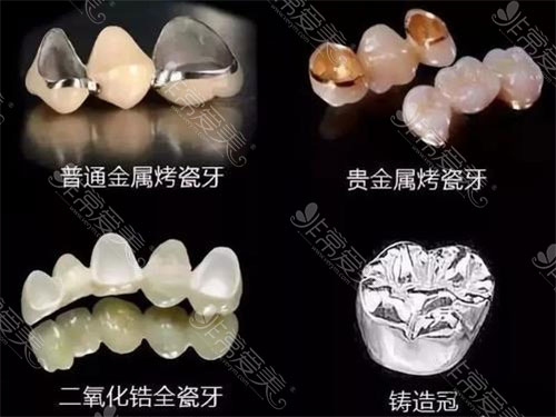 种植牙牙冠的材质照片