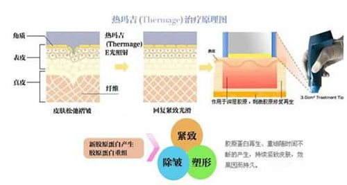 热玛吉治疗原理图示