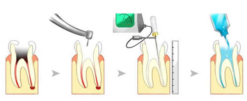 牙髓炎的治疗方式