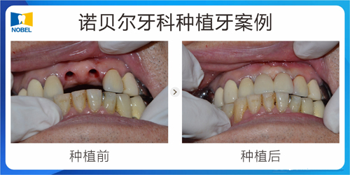 西安诺贝尔口腔种植牙<span style=