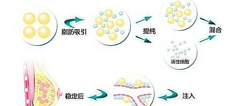 自体脂肪填充示意图