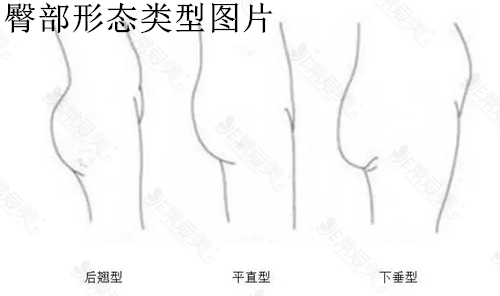 臀部形态类型图片