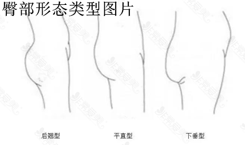 臀部形態(tài)類型圖片