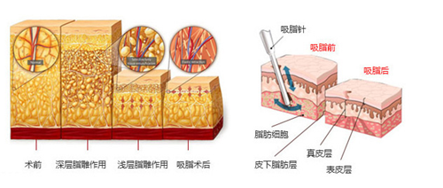 杭州格莱美彭涛医生的FSE分层吸脂怎么样？是什么原理？