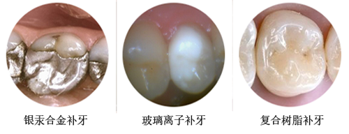 补牙材料