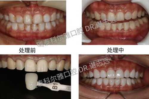 長沙瑞泰科爾雅口腔瓷貼面