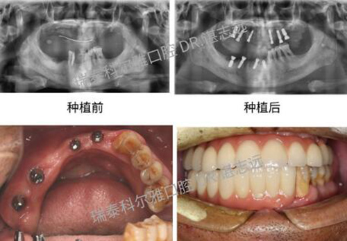 长沙瑞泰科尔雅口腔全口种植