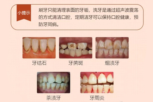 去牙科洗一次牙多少钱?兰州洗牙去哪儿比较好?