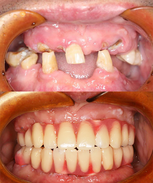 口腔医生告诉你种植牙有条件限制!不是所有人都能种牙