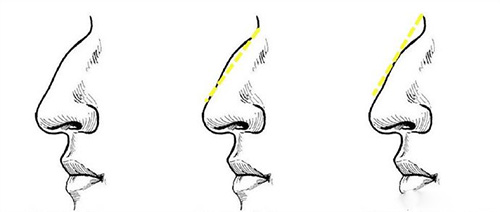 驼峰鼻图示