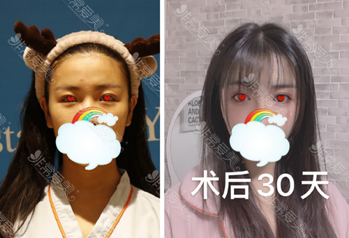 美杜莎美眼术是噱头吗？眼综合真人恢复全过程图分享！