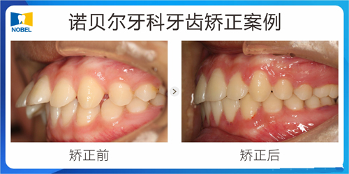 諾貝爾牙科牙齒矯正<span style=