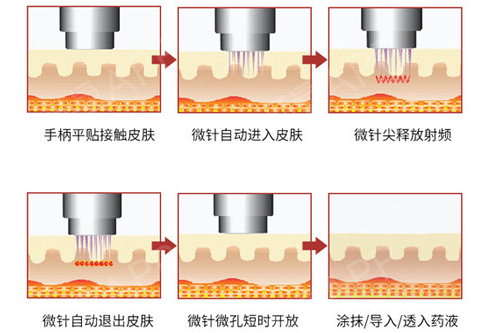 黄金微针作用原理