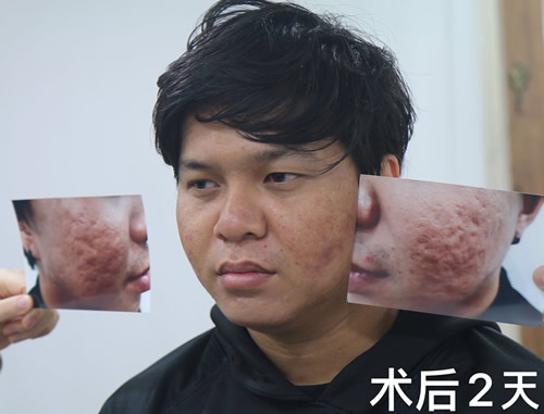 自体真皮再生术治疗面部痘坑前后效果对比