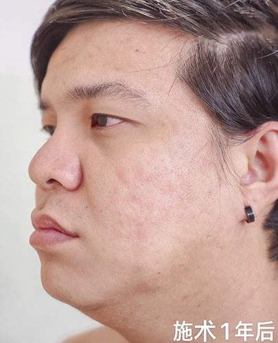 自体真皮再生术治疗面部痘坑一年后效果展示