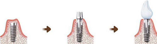 种植牙过程图示